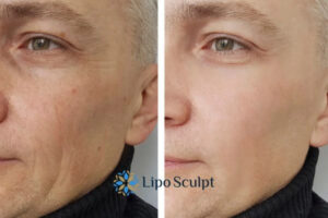 How to Fight Aging Symptoms 3 Fight Aging Symptoms Beeston Hill With HIFU and Morpheus8 Today!