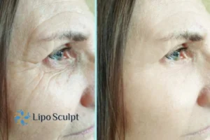 How to Fight Aging Symptoms 2 Do you want to Fight Aging Symptoms Beeston Hill? Contact Lipo Sculpt today!