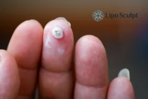 Cryopen Top 5 Treatable Conditions 4 Do you have a persistent wart of verruca that you cannot shit? Cryopen Beeston Hill treatment will work call us NOW!
