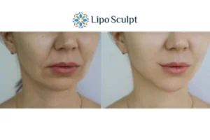 Explaining Total Skin Tightening Treatment And What It Can Do For You 2 Do you want to boost your self confidence? Give Morpheus8 Beeston Hill a try today!