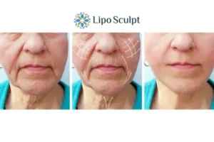 Explaining Total Skin Tightening Treatment And What It Can Do For You 3 Boost your confidence with Morpheus8 Beeston Hill call our team today!