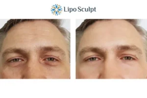 Explaining Total Skin Tightening Treatment And What It Can Do For You 6 Morpheus8 Beeston Hill book in today to find out more!