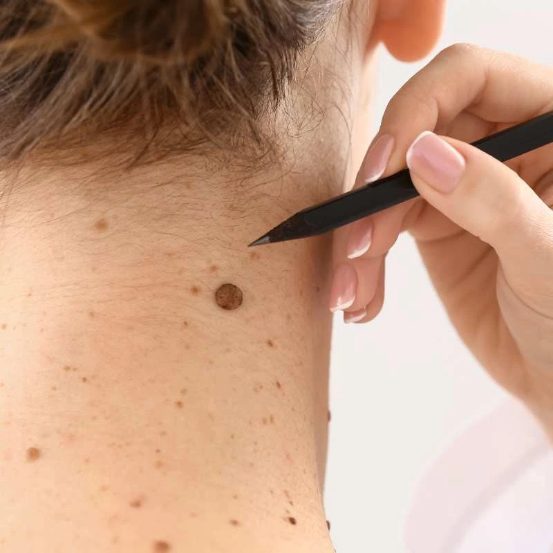 How to Support Your Body During Pregnancy for Faster Postnatal Recovery 5 See our lesion removal prices Beeston Hill - call today for a free quote